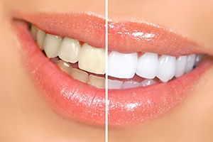 Closeup of patient's smile before and after teeth whitening