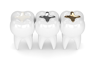 3D rendering of 3 teeth with tooth-colored, silver, and copper fillings