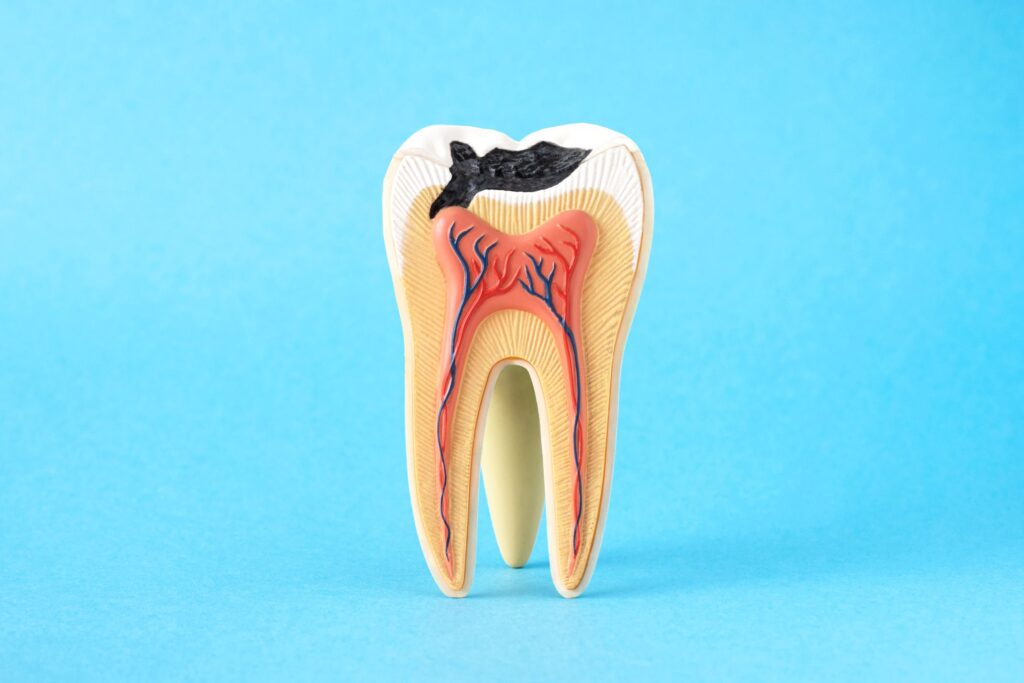 Large model tooth showing roots and a cavity in the biting surface